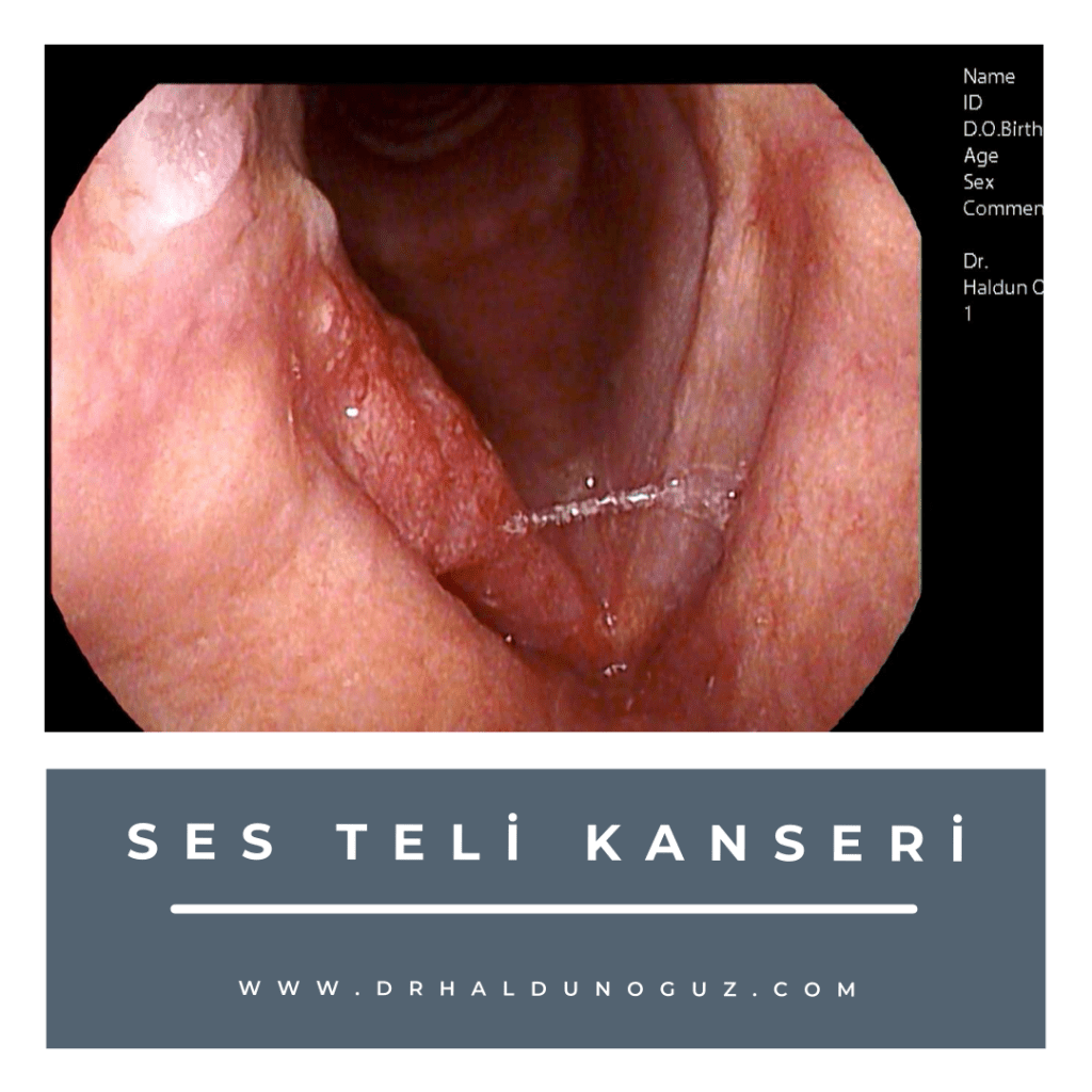 Ses Teli Tahrişi Belirtileri ve Etkili Rahatlatma Yöntemleri [2026]